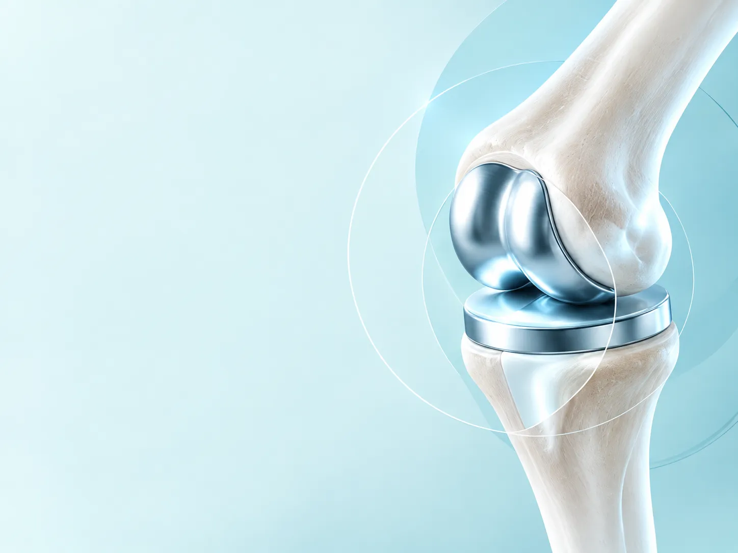 Illustrated knee replacement implant in cool clinical light
